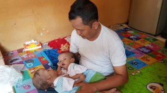 Tolong... Bayi Kembar Siam Ini Lahir Dengan Jantung dan Hati Menyatu