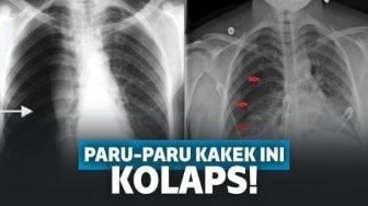 Banyak Gaya, Kakek Ini Terlalu Semangat Nyanyi Sampai Paru-parunya Kolaps