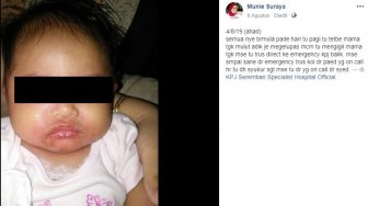 Digendong Sembarang Orang, Bayi 5 Bulan Derita Infeksi Kulit Parah!