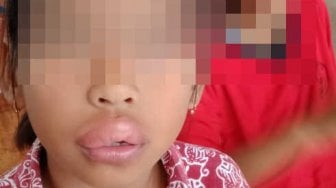 Bibir Siswa SD Ini Jontor Usai Makan Es Krim, Polisi Buru Pedagang