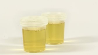 6 Jenis Makanan dan Minuman yang dapat Menyebabkan Warna Urine Menjadi Keruh