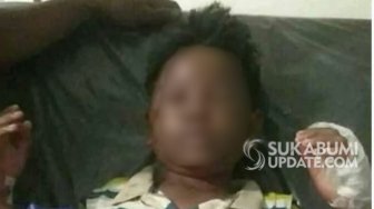 Terbakar, Kakak Adik Ditangani Dokter Spesialis Bedah Plastik 