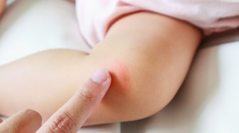 Belajar dari Kondisi Anak Mona Ratuliu, Kenali 6 Jenis Dermatitis!