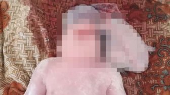 Miris, Otak Bayi Ini Berada di Luar Tempurung, Diduga Terpapar Zat Kimia