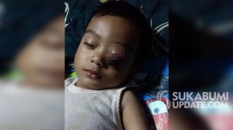 Balita Asal Kabandungan Sukabumi Tumor Mata, Camat Minta Kepala Desa Udunan