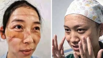 Wajah Petugas Medis di China Memar Terlalu Lama Pakai Masker