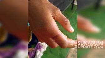 Kondisi Siswi MI di Jampang Tengah Sukabumi Diserang Pria Tak Dikenal