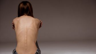 Mengenal Anoreksia Nervosa: Tidak Semua Penderitanya Terlihat Sangat Kurus