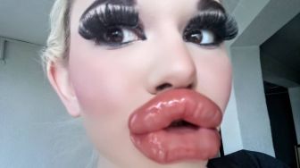 Lakukan Filler 20 Kali, Perempuan Ini Mengaku Cintai Bibir Tebalnya