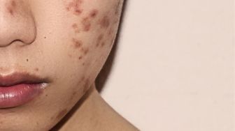 Bahaya Pakai Skin Care Abal-abal, Bisa Bikin Kulit Rusak Hingga Kanker!