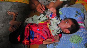 Bayi Gizi Buruk Usia 20 Bulan di Cianjur Meninggal Dunia