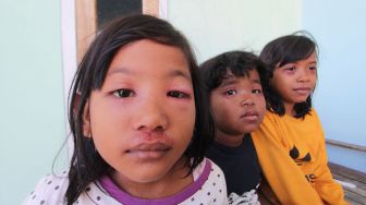 Sejumlah anak menunjukkan luka akibat serangan Semut Semai atau serangga Tomcat (Paederus littoralis) di desa Pabean udik, Indramayu, Jawa Barat, Selasa (1/9/2020). [ANTARA FOTO/Dedhez Anggara]