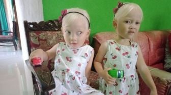 Viral Bocah Kembar Albino Wonogiri, Kenali Sebab dan Cara Merawatnya