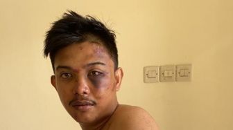 Ini Luka-luka Dosen UMI Korban Salah Tangkap yang Dihajar Polisi