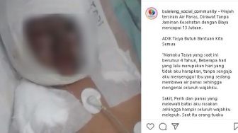 Wajah Melepuh Tersiram Air Panas, Tasya Balita di Buleleng Butuh Bantuan