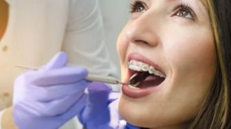 Tak Sekadar Merapikan Gigi, Ternyata Ada 5 Manfaat Pakai Behel yang Bisa Kamu Dapatkan