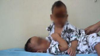 Bayi Kembar Siam Jalani Operasi Pemisahan di RSUP Adam Malik Hari Ini