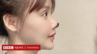 Kisah Aktris China Usai Bedah Kosmetik, Ujung Hidung Rusak