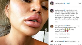 Bibir Chrissy Teigen Bengkak Usai Gigit Kulit Jeruk, Alergi?