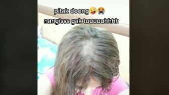 Tergiur Salon Harga Murah, Gadis Ini Alami Kerontokan hingga Nyaris Botak