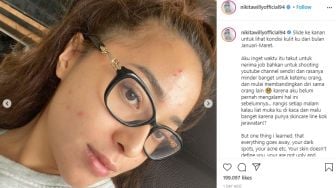 6 Foto Transformasi Wajah Nikita Willy Dari Jerawatan Sampai Mulus