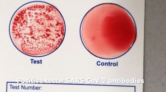 Terpopuler Kesehatan: Alat Tes Antibodi Vaksin Covid hingga Cara Redakan Nyeri Tanpa Obat