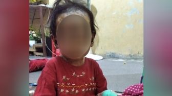 Pak Gubernur, Tolong Bantu Bocah 5 Tahun Kena Penyakit Kulit Aneh di Medan