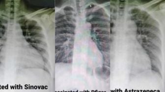 Viral Foto Paru-paru Pasien COVID-19 Setelah Divaksin Sinovac, Astrazeneca, dan Pfizer