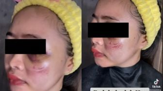 Viral Wajah Pengantin Babak Belur Jelang Pernikahan, Hasil Riasan MUA Jadi Sorotan