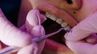 Viral Balita Dipasang Behel, Kenali 6 Bahaya Memasang Kawat Gigi Pada Anak Balita