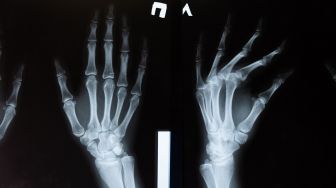 4 Kebiasaan Ini Ternyata Bisa Bikin Osteoporosis di Usia Muda