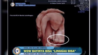 Viral Foto USG Bayi Berpose Acungi Jempol Simbol &#039;Oke&#039;, Wali Kota Sampai Angkat Bicara