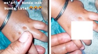 Viral Ibu Panik Lihat Jari Anaknya, Merasa Bersalah Pakaikan Cincin