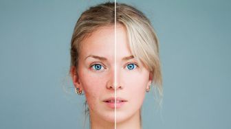 5 Kandungan Skincare yang Ampuh untuk Bekas Jerawat