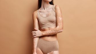 Kerap Dirundung, Begini Cara Unik Hilangkan Diskriminasi Pada Orang Dengan Vitiligo