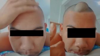 Viral Pria Pamer Benjolan Kepalanya Mirip Jarjit di Upin Ipin, Publik Menangis