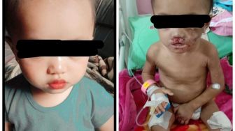 Dianiaya Calon Ayah Sambung, Bayi di Kota Batu Terluka Disiram Air Panas