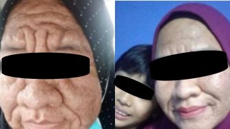 Sampai Disumpahin, Perempuan Alami Wajah Menua Mirip Nenek-Nenek Selama Kehamilan