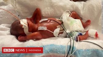 Kisah Bayi Paling Prematur, Lahir Saat Usia Kehamilan Ibunya Baru 21 Minggu