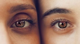 Mata Bintik-bintik Bisa Jadi Tanda Kolesterol Tinggi, Kapan Harus ke Dokter?