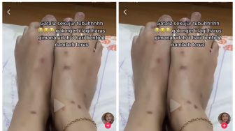 Gegara Pindah Kos, Wanita Syok Lihat Sekujur Tubuh Dipenuhi Bentol, Ternyata Karena Ini