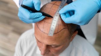 Mau Transplantasi Rambut? Kenali Dulu Yuk Beberapa Tekniknya