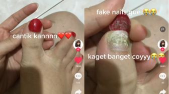 Keseringan Gunakan Fake Nails, Kuku Wanita Ini Berjamur Hingga Terkikis