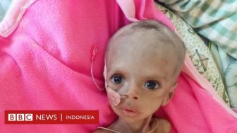 Perang Saudara di Etiopia: RS di Tigray Kehabisan Makanan untuk Anak