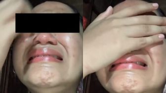 Cewek Nangis Kejer Makan Tulang Ayam, Kondisi Gigi Bikin Meringis 'To The Bone'