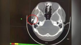 Sering Sakit Kepala Parah, Ternyata Ada Peluru Telah 20 Tahun Bersarang di Tengkorak Lelaki Ini