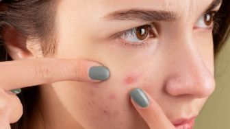 Ingin Beli Produk Skincare untuk Mengatasi Jerawat? Berikut 6 Bahan Aktif yang Dibutuhkan