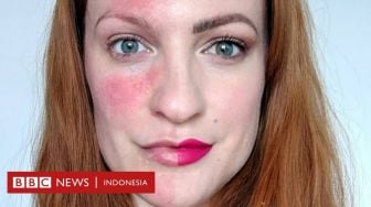 Kisah Pengidap Rosacea Berjuang Mengatasi Dampak Gangguan Kulit