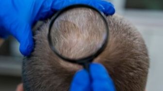 Kabar Baik, Peneliti Berhasil Temukan Obat yang Mampu Tumbuhkan Rambut Botak Secara Penuh
