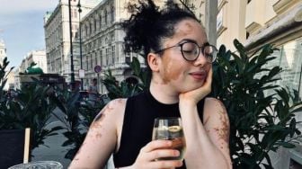 Dulu Diejek Mirip Sapi Perah karena Mengidap Vitiligo, Wanita Ini Buktikan Dirinya Bisa Jadi Model